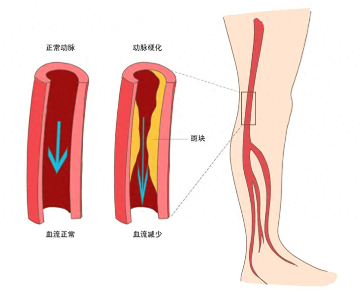血糖高不高，看脚就知道，若没有这3种情况，说明血糖控制的不错