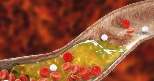 山东一男子，糖尿病中期，每天吃洋葱降糖，半年后如何了?