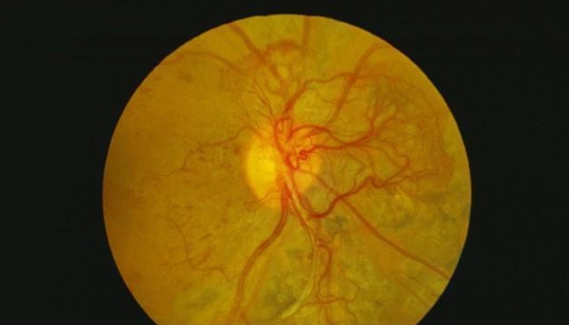 糖尿病人身体有7个信号，当心血糖失控